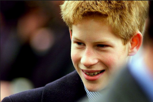 Prince Harry with braces - mBraceables 