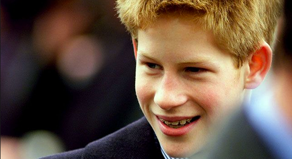 Prince Harry with braces - mBraceables